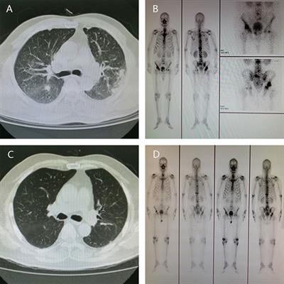 Which Way to Choose for the Treatment of Metastatic Prostate Cancer: A Case Report and Literature Review